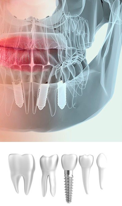 implantología dental de calidad